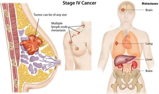 cancer breast Chinese inflammatory drywall